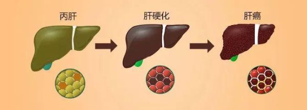 丙肝是怎么回事严重吗？（澳链币今日市值）